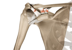 AC Joint Separation