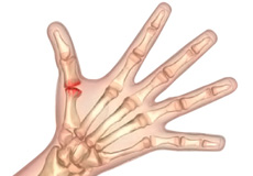 Arthritis of the Hand and Wrist