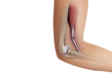 Bicep Tendon Tear at the Elbow