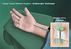 Endoscopic Carpal Tunnel Surgery