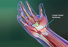 Carpal Tunnel Syndrome