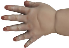 Congenital Defects of the Hand and Wrist