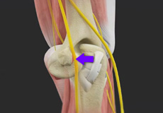 Cubital Tunnel Release