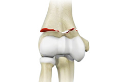 Distal Humerus Fractures of the Elbow