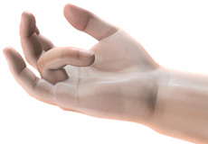 Dupuytren's Contracture