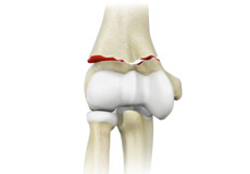 Elbow Fractures