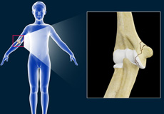 Elbow Fractures in Children