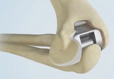 Total Elbow Replacement