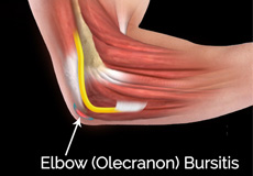 Elbow (Olecranon) Bursitis