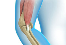 Elbow Tendon and Ligament Repair