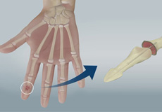 Finger Joint Fusion