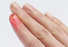 Fingertip Injury