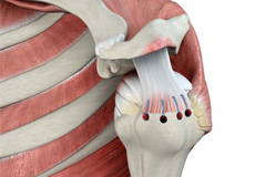 Rotator Cuff Repair