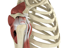 Rotator Cuff Tear