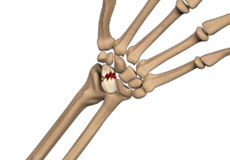 Scaphoid Facture