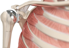 Shoulder Joint Replacement