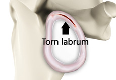 Shoulder Labral Tear