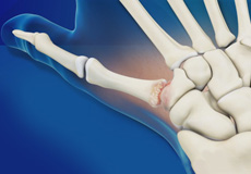 Surgery for Thumb and Digit Arthritis