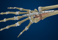 Total Wrist Arthrodesis