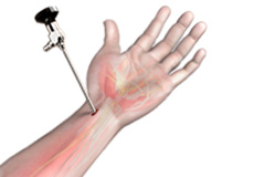 Wrist Arthroscopy