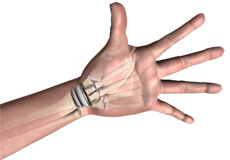 Wrist Joint Replacement