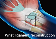 Wrist Ligament Reconstruction