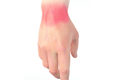 Wrist Sprain